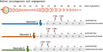 Transfusion-Free Survival Predicts Severe Retinopathy in Preterm Neonates